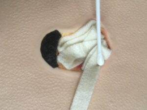 Calcium alginate rope in wound